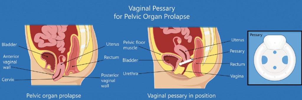 Vaginal Pessary for Pelvic Organ Prolapse